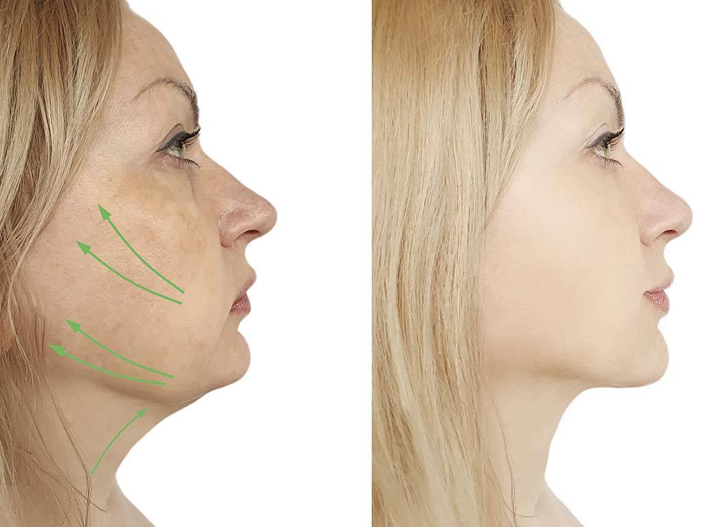 Before and after of neck liposuction, Honolulu, Hawaii. Licensed plastic surgeon for liposuction.