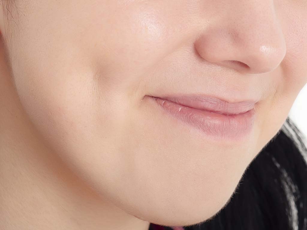 Cheek dimpleplasty, Oahu. Dimple creation, Honolulu, HI.