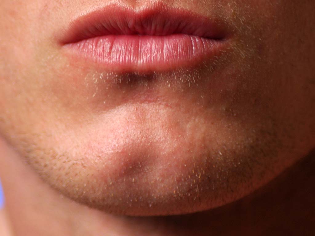 Hawaii Facial Plastic Surgery chin dimple procedure, Honolulu, HI.