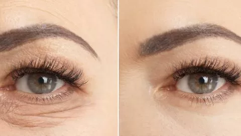 Before and after of lower eyelid surgery, Honolulu HI.