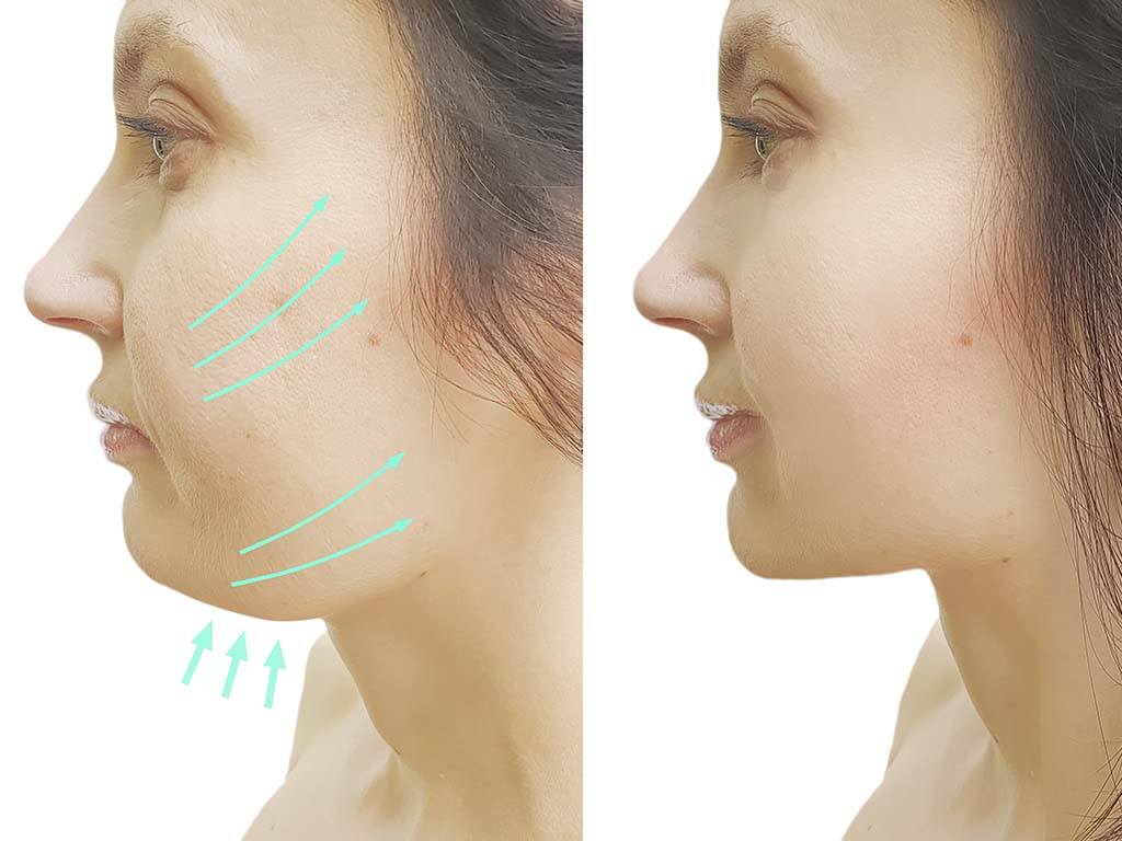 Before and after of chin liposuction, Honolulu HI.