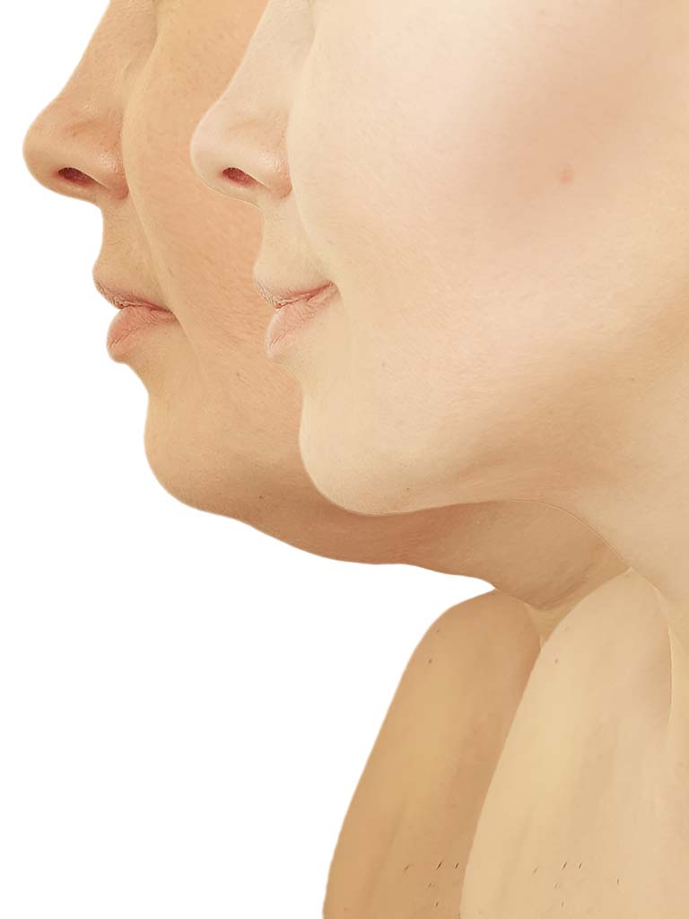 Honolulu neck liposuction procedure before and after.