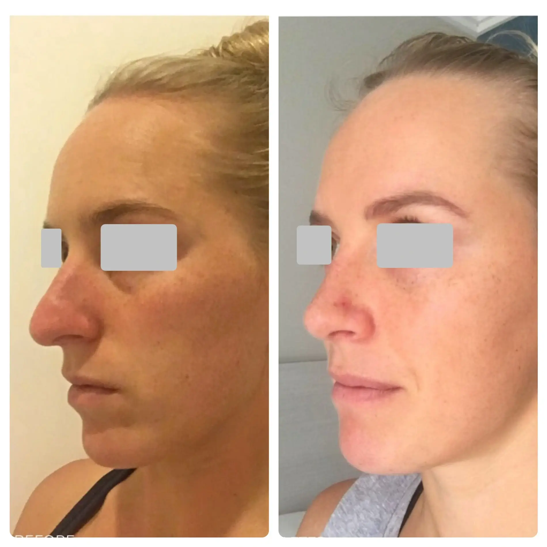 Surgical Rhinoplasty (Nose Surgery) Treatment