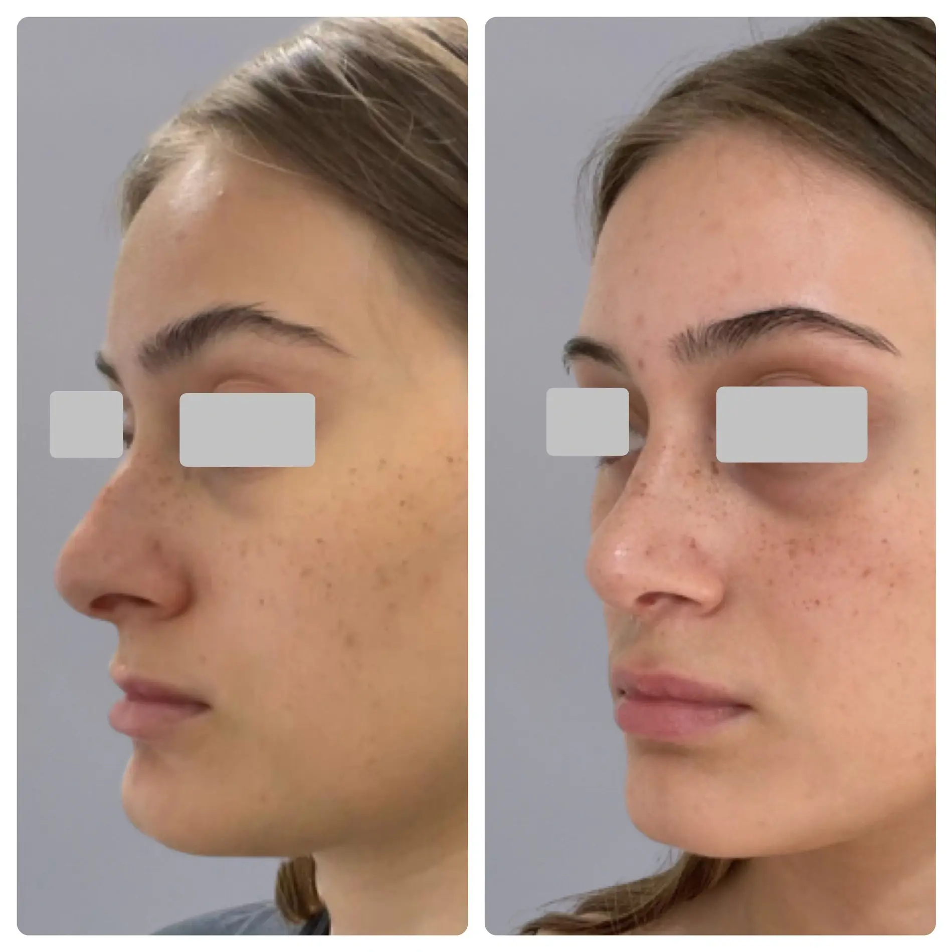 Surgical Rhinoplasty (Nose Surgery) Treatment