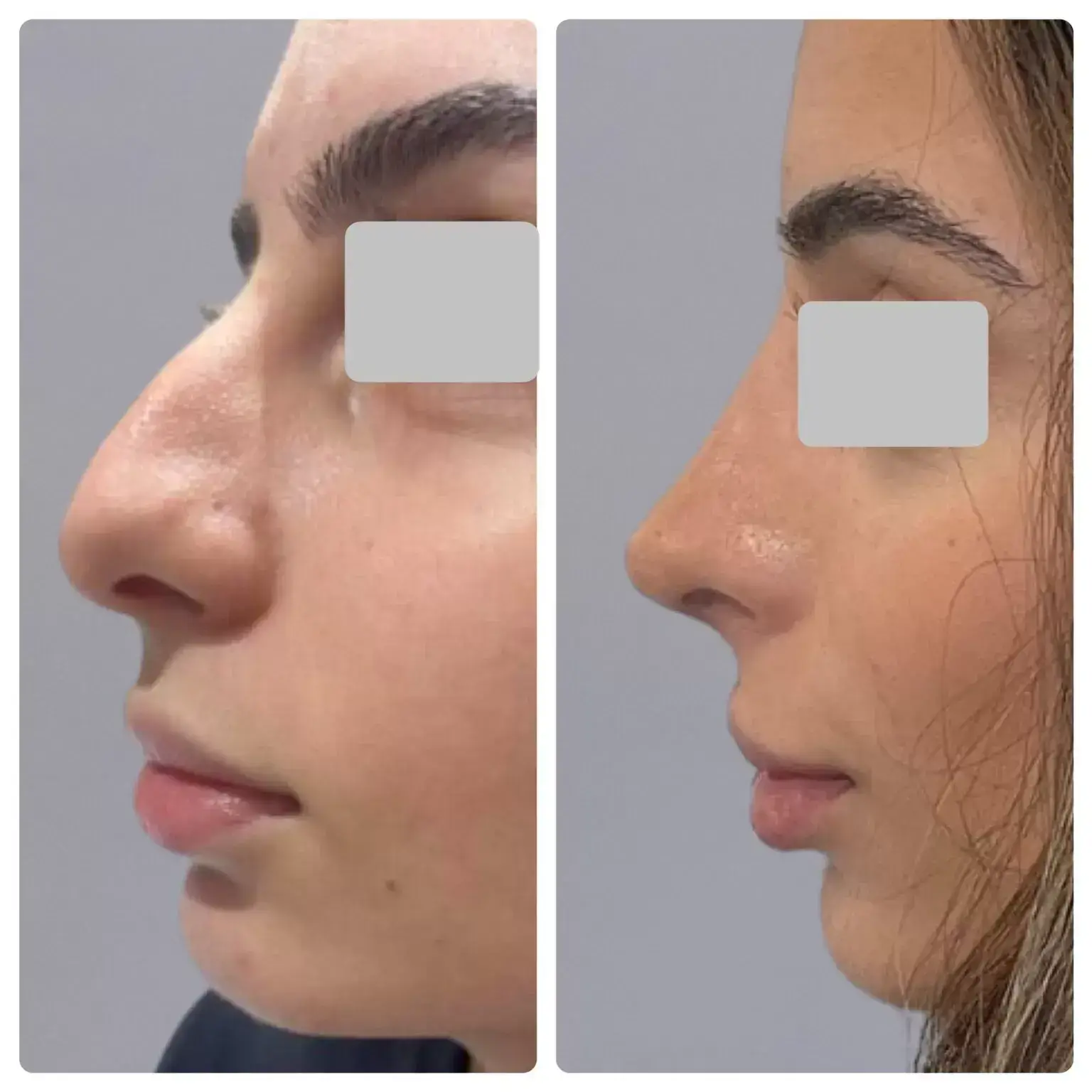 Surgical Rhinoplasty (Nose Surgery) Treatment