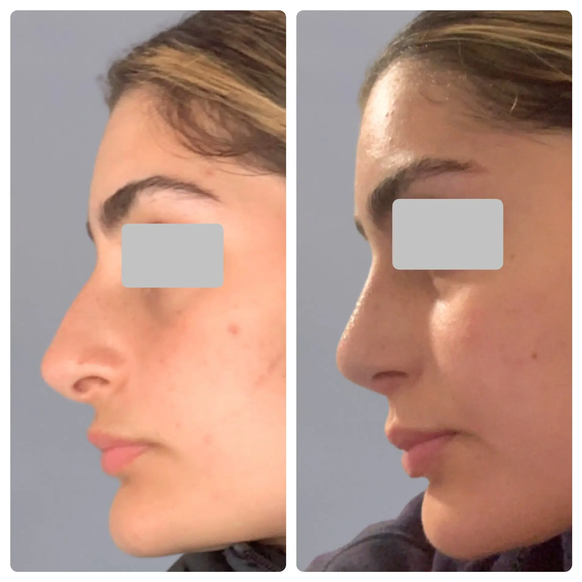 Surgical Rhinoplasty (Nose Surgery) Treatment