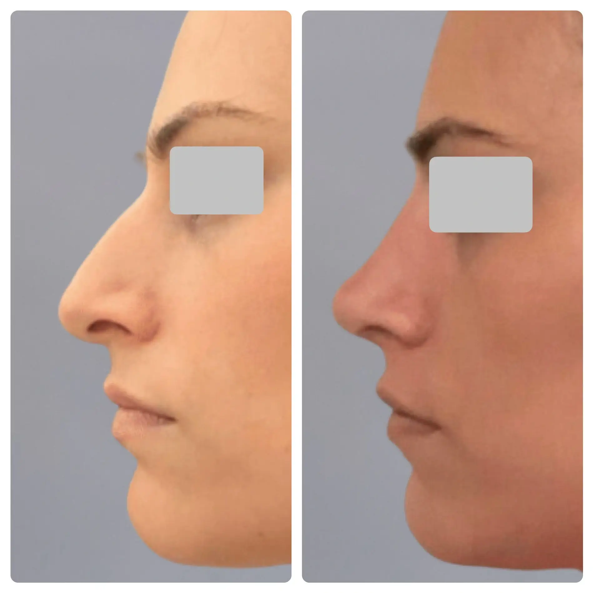Surgical Rhinoplasty (Nose Surgery) Treatment