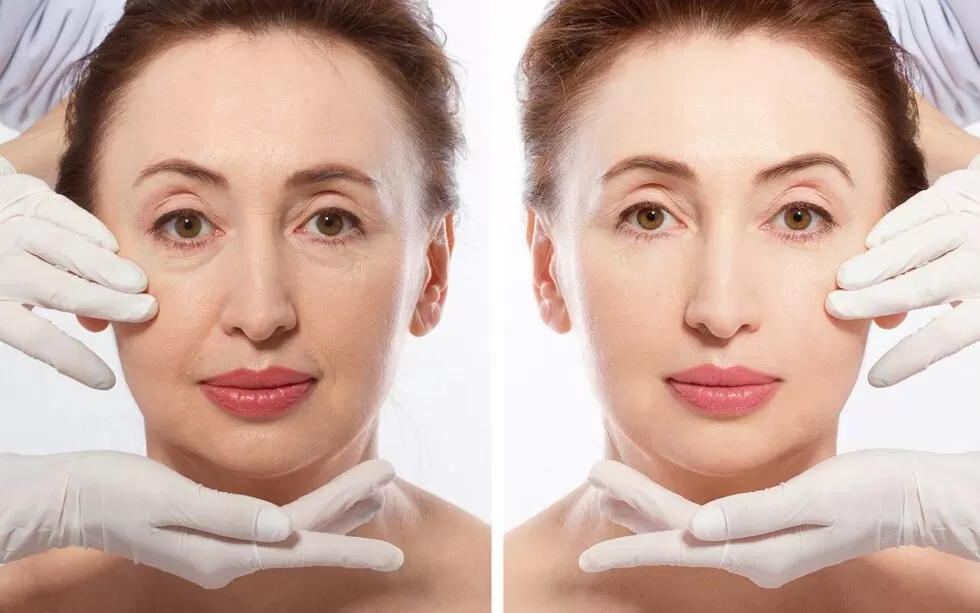 SculptraÂ® Aesthetics | Honolulu Facial Contouring - Dr. Susan Tan