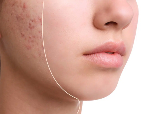 Before and after results of laser acne peel, Honolulu. Treatment for acne scarring, Hawaii.
