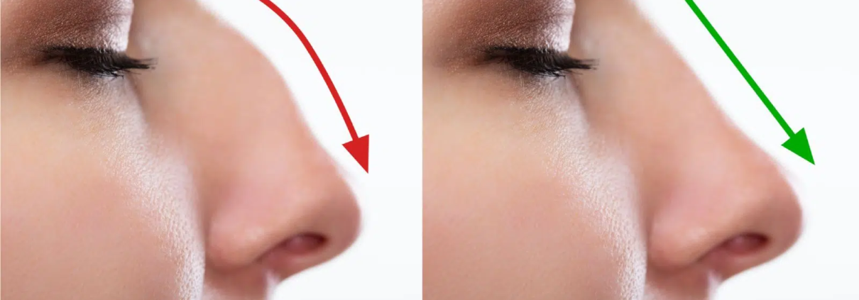 What I Wish I Knew Before Rhinoplasty - Dr. Susan Tan
