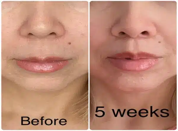 Lip Lifts in Honolulu (1) Before and after of an Oahu lip lift surgery in Honolulu. Lip lifting in Hawaii 5 weeks after show natural looking results that reverse the effects of aging.