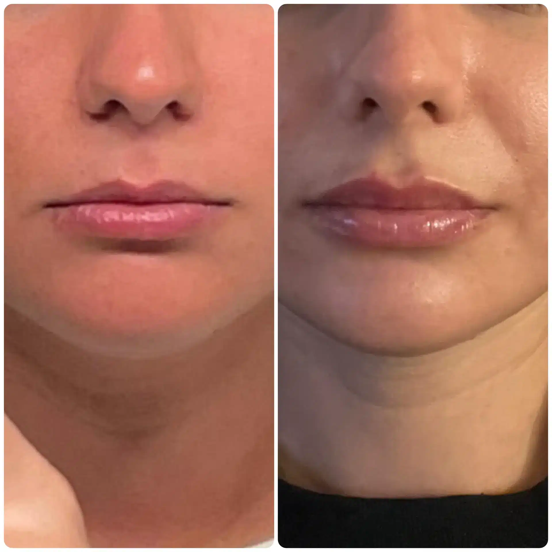 image1 (1) Results of a modified upper lip lift. Oahu lip lift surgeon in Honolulu reshapes the upper lip with an strategic incision to minimize lip scarring.