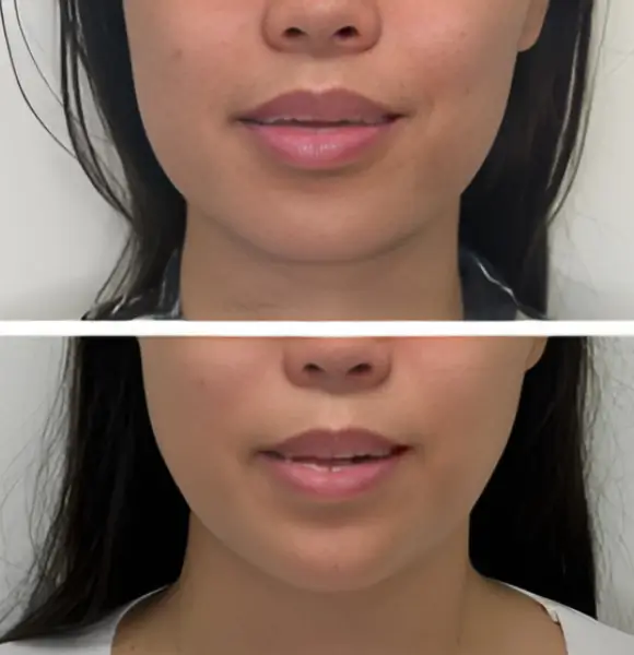 fat-grafting-safety Top and bottom before and after close-up photos of a woman’s lower face, highlighting enhanced perioral skin texture and subtle lip volume after a nanofat treatment.