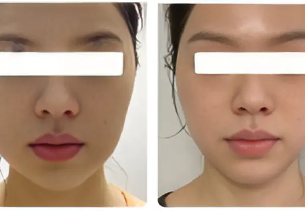 fat-grafting-vs-fillers Side-by-side before and after photos of a female patient with white privacy bars over her eyes, demonstrating natural-looking facial volume restoration as a longer-lasting alternative to dermal fillers.