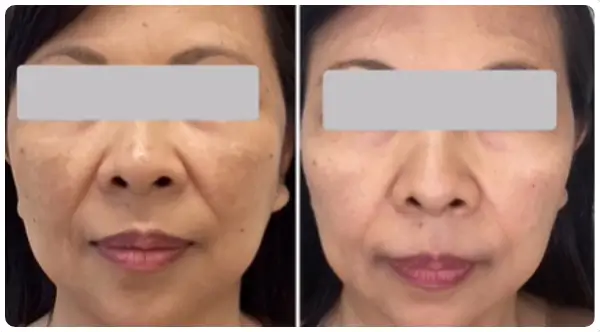 SkinPen Microneedling with PRP comparison of before and after treatment shows improved skin texture and reduced signs of aging.