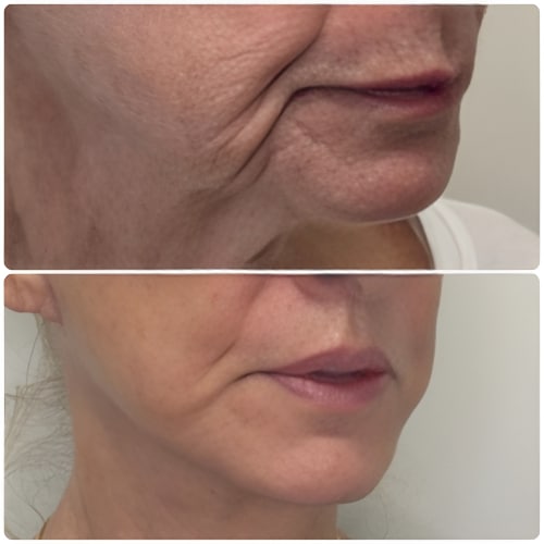Split image of crepey lip lines and a slack jawline beside a refreshed result, illustrating the deflated look of facial volume loss.
