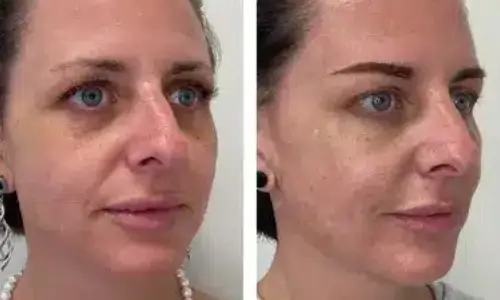 Before and after midface comparison from Hawaii Facial Plastic Surgery, with less under eye hollowing and a smoother cheek transition.