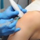 Barbotage procedure for calcific tendonitis using ultrasound guided minimally invasive treatment at Hawaii Island clinic