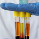 A medical professional in blue gloves holds three test tubes of separated blood components, representing Platelet-Rich Plasma orthobiologic therapy.